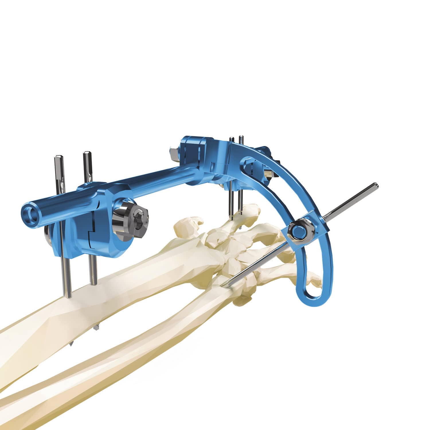 Wrist external fixation system 5002007ST MIKAI radius / ulna / hybrid