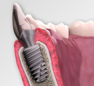 conical dental implant