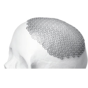 cranial implant