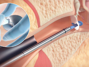 tympanostomy tube