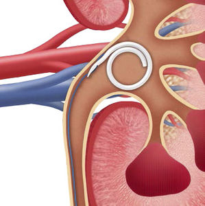 ureteral stent 1