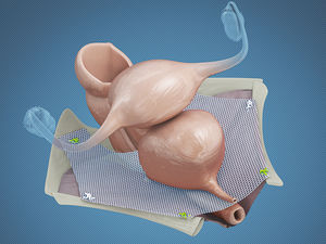 pelvic floor reconstruction reconstruction mesh