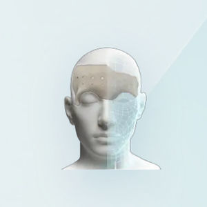 facial implant 1