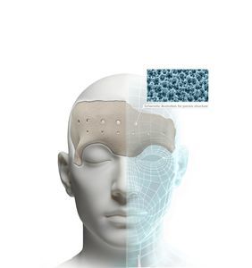 3D-printed implant