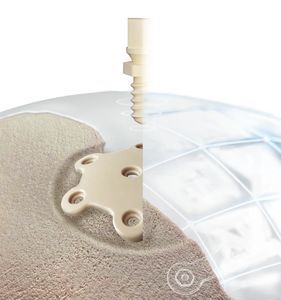 custom-made cranial implant