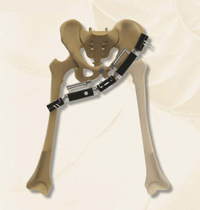 pelvis external fixation system