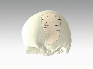 custom-made cranial implant