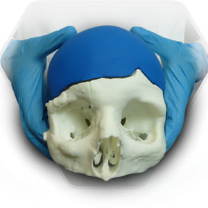 custom-made cranial implant