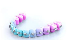 NiTi orthodontic wire 1