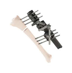tibia external fixation system 1