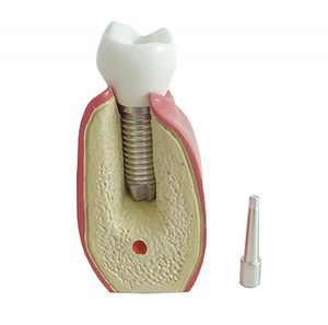 dental model / for demonstration / for implantology