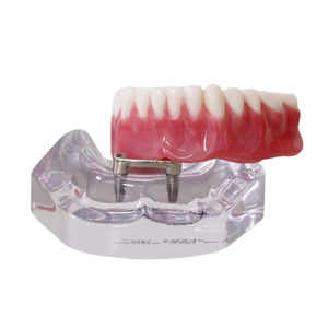 denture model 1