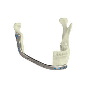 custom-made mandibular implant