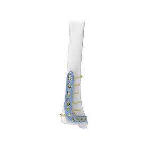 tibia compression plate