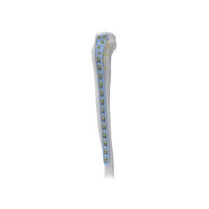 tibia compression plate 1