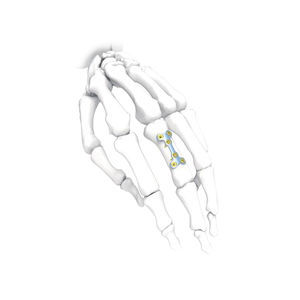hand compression plate 1