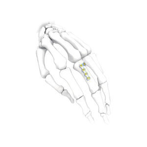 hand compression plate 1