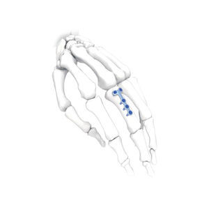 hand compression plate 1