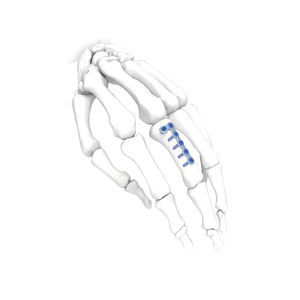 hand compression plate 1