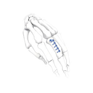 hand compression plate 1