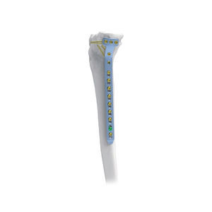 tibia compression plate 1