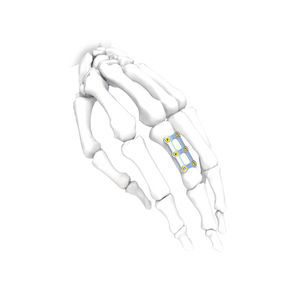 hand compression plate 1