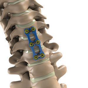 cervical arthrodesis plate