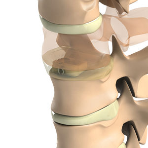 cervical interbody fusion cage