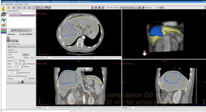 radiation therapy software