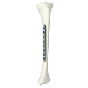 humerus compression plate