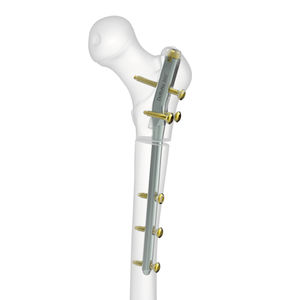 femoral intramedullary nail