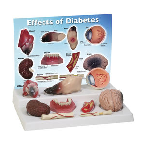 diabetes model