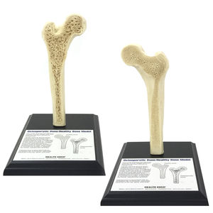 osteoporosis awareness anatomical model