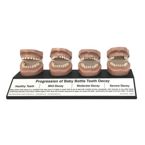 tooth decay anatomical model