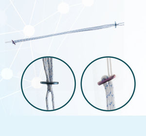 ACL reconstruction suture button