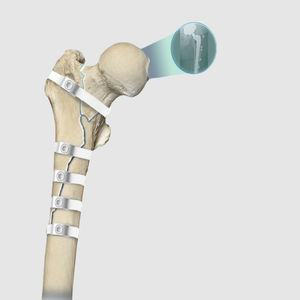 hip revision surgery bone cerclage wiring