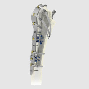 femoral periprosthetic plate