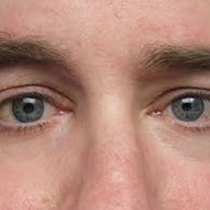 orbital cosmetic prosthesis / adult