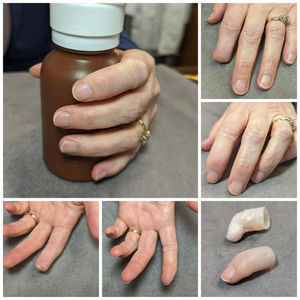 finger cosmetic prosthesis