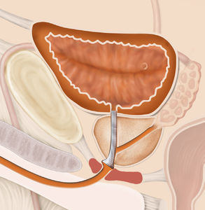 prostatic stent