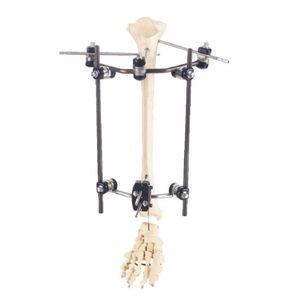 tibia external fixation system