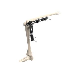 knee external fixation system