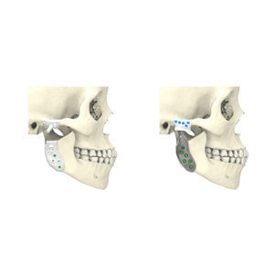 custom-made mandibular implant