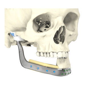 custom-made mandibular implant