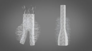 abdominal aorta vascular prosthesis