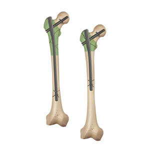 femoral intramedullary nail