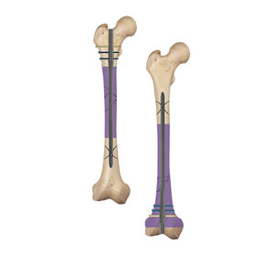 femoral intramedullary nail