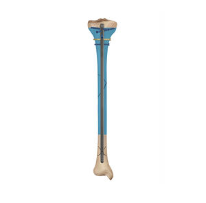 tibial intramedullary nail