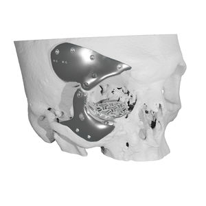 maxillofacial compression plate