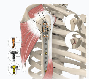 humerus compression plate 1